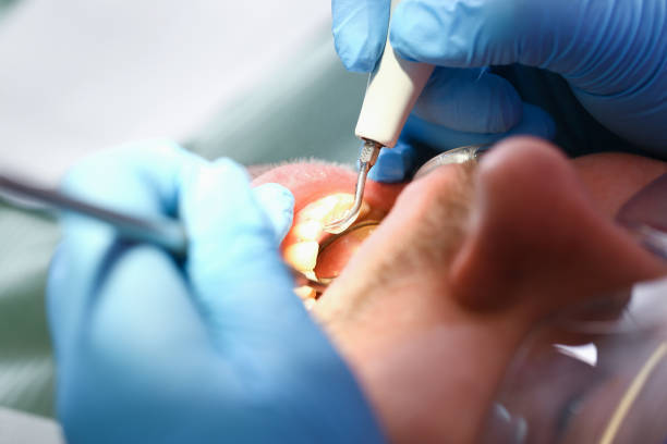 Best Emergency Tooth Extraction in Parker, FL